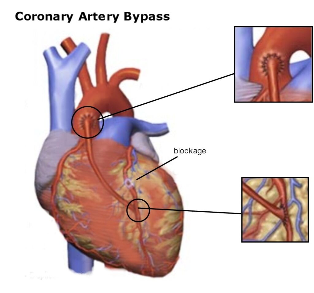 Healthier You Coronary Artery Bypass Surgery(CABG) Healthier You
